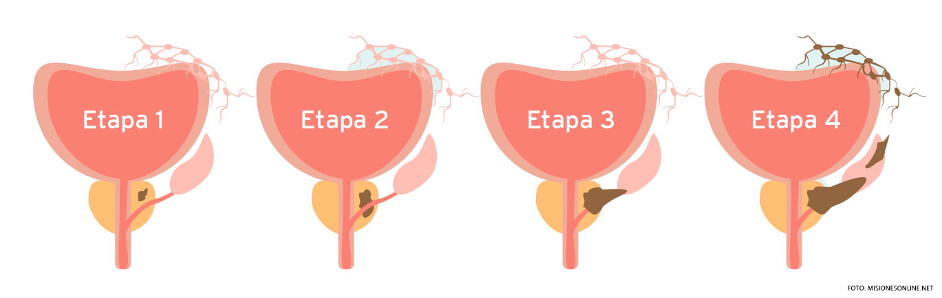 Cáncer de próstata