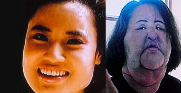 Inyecciones de silicona y aceite