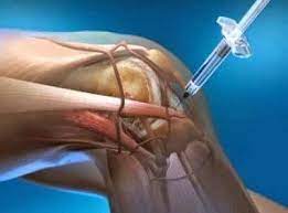 Testimonio lesión rodilla resuelta con Plasma Rico en Plaquetas