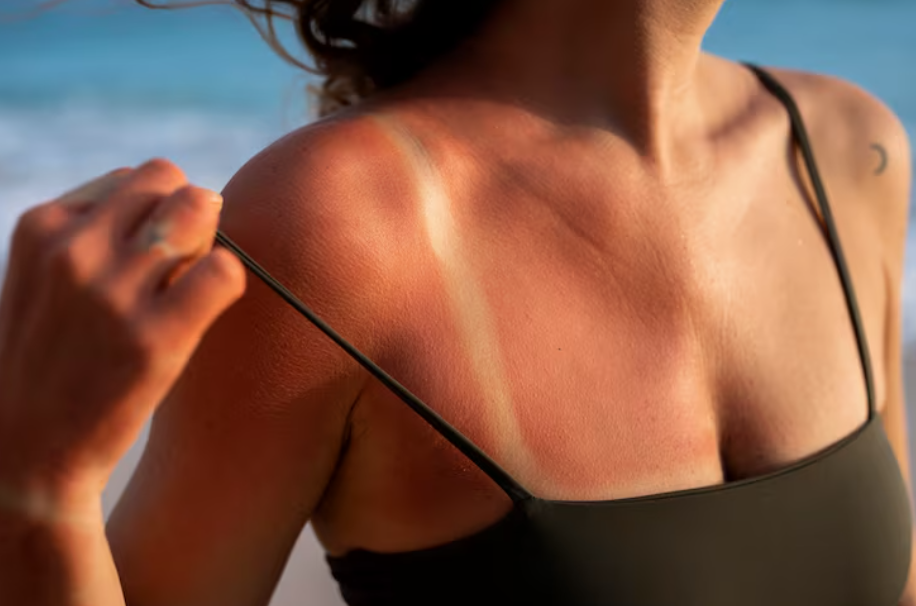 Tanorexia cuando broncearse más y más nunca es suficiente